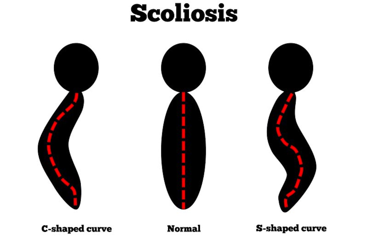Diagram of three spine shapes: C-shaped curve, Normal, and S-shaped curve